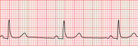 Decode EKG Strips Like a Pro: Practice Makes Perfect!